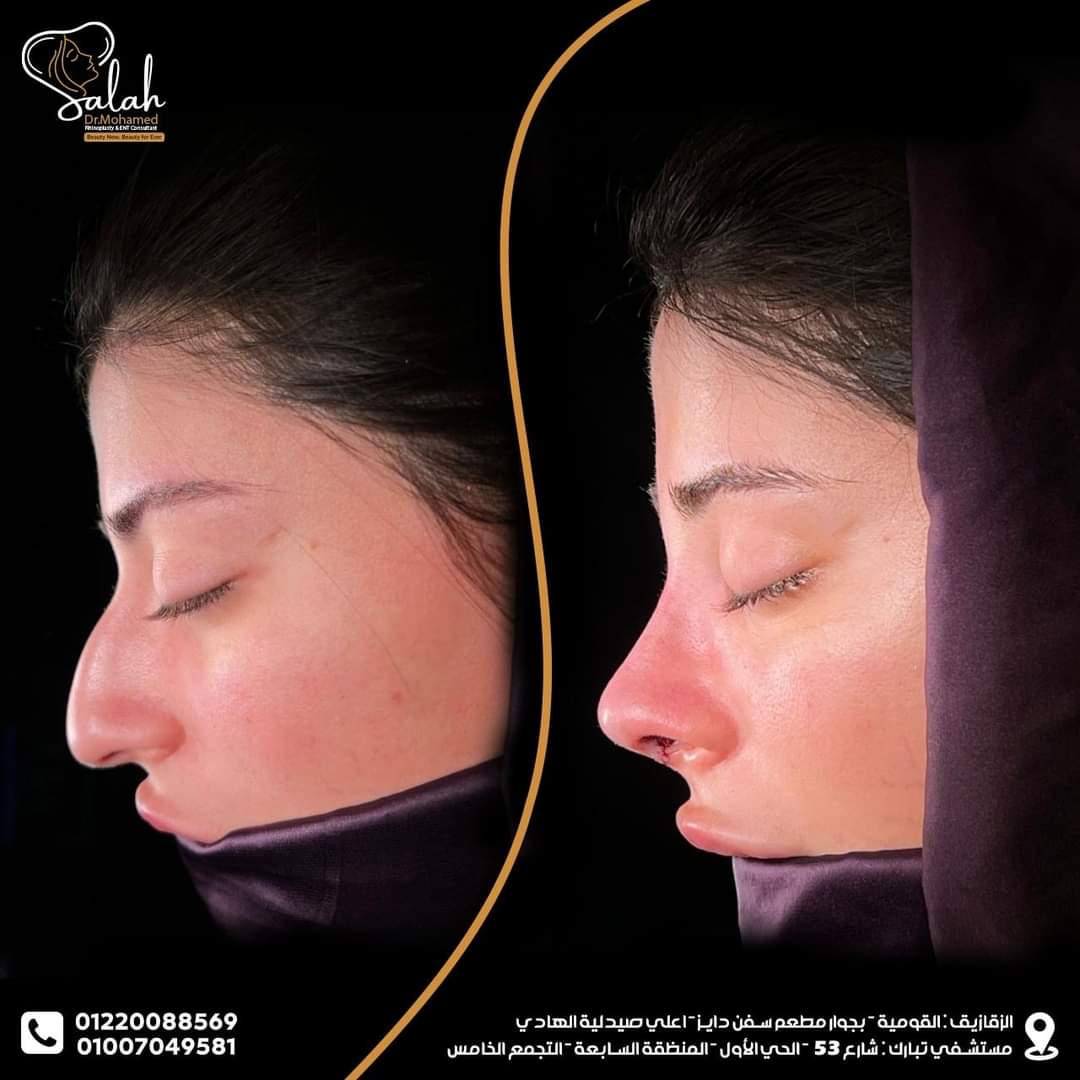 Droopy Tip Rhinoplasty